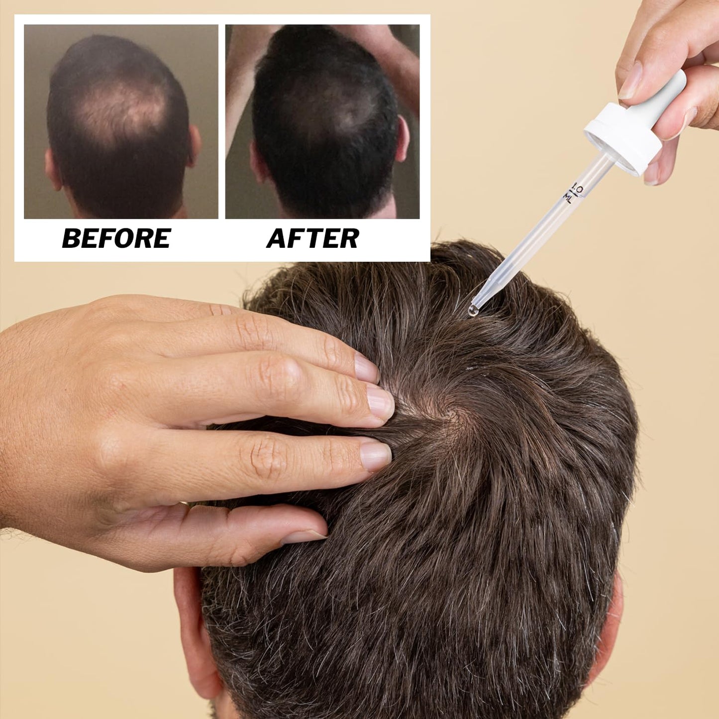 Shapiro MD Hair Growth Experts Men's Regrowth Kit Plus: Shampoo, Conditioner, 5% Minoxidil, Leave-In Foam, Complete Anti Hair Loss and Thinning Hair Solution for Men, 1 Month Supply