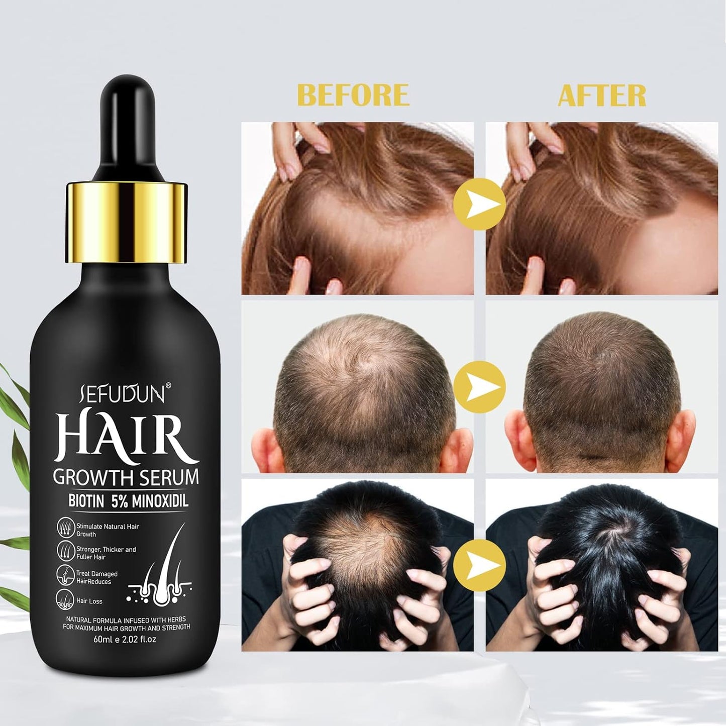 Minoxidil Hair Growth Serum for Men and Women, 5% Minoxidil with Biotin for Scalp Hair Loss and Thinning, Promotes Natural Thicker, Longer, Fuller Healthier Hair, 2.02 oz