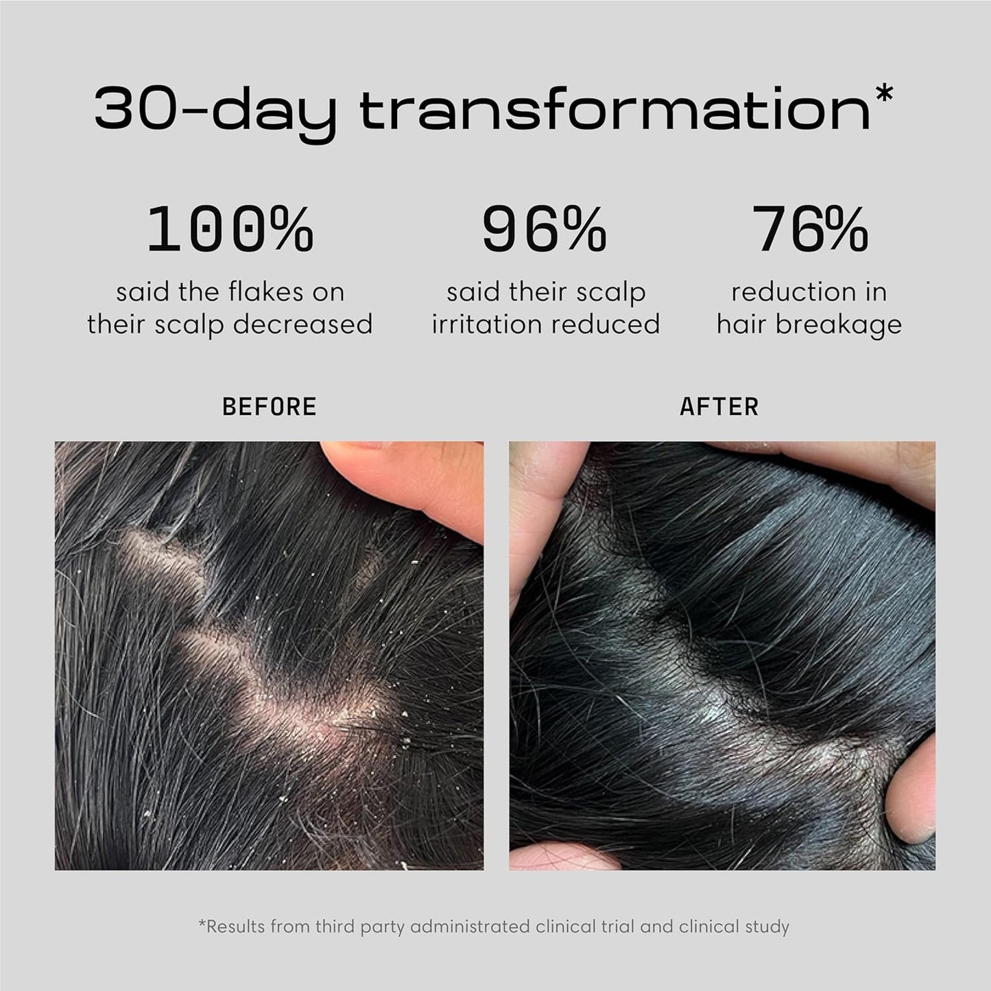 Jupiter Anti Dandruff Shampoo - Shampoo for Men & Women for Flaky, Itchy, Oily, & Dry Scalp - Nourishes Scalp and Reduces Breakage & Flakes - Color-Safe, Sulfate-Free, Paraben-Free - 2 Pack