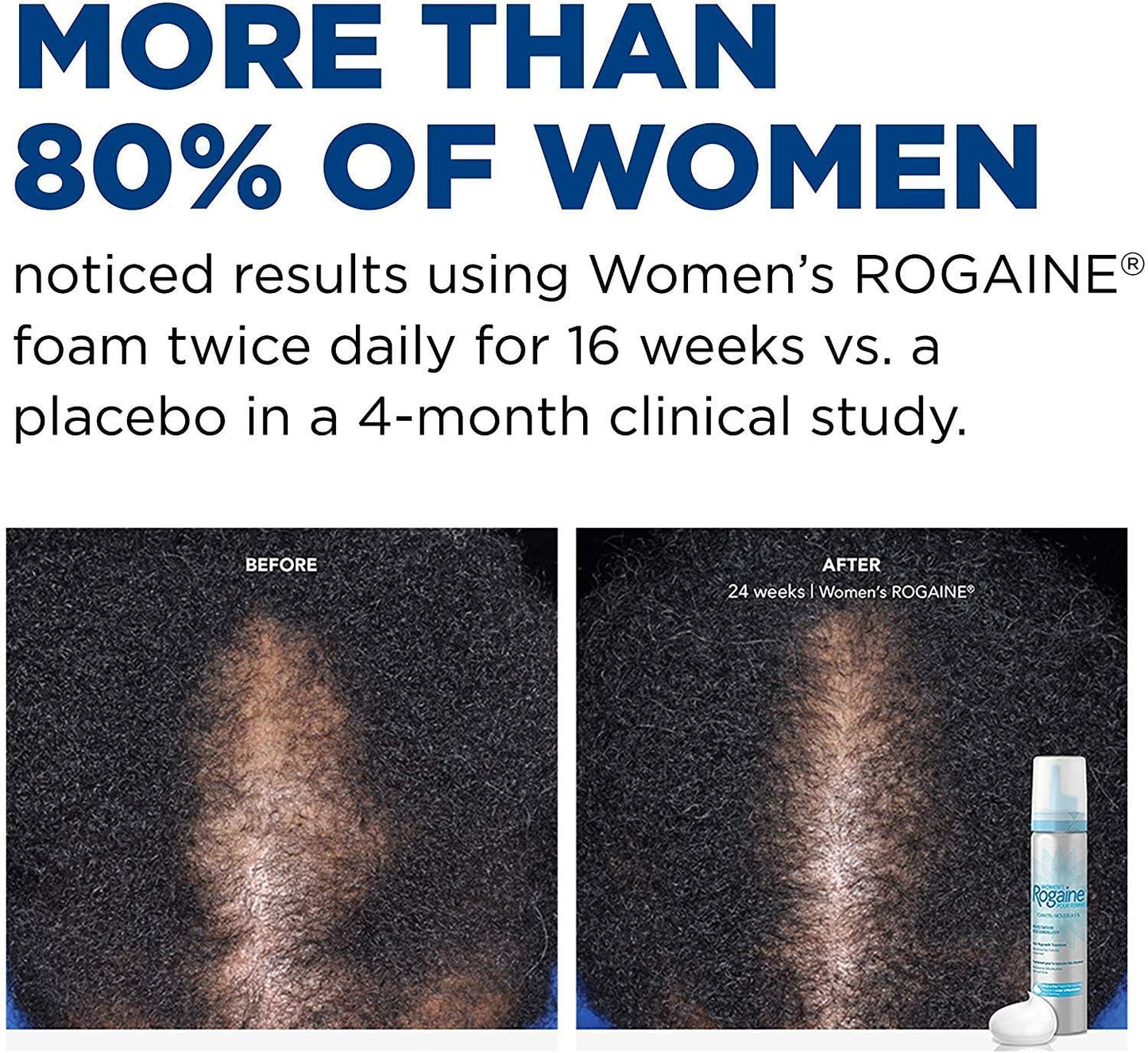 Rogaine 5% Minoxidil Foam, Topical Once-A-Day Hair Loss Treatment for Women to Regrow Fuller, Thicker Hair, Unscented, 2-Month Supply, 2.11 oz
