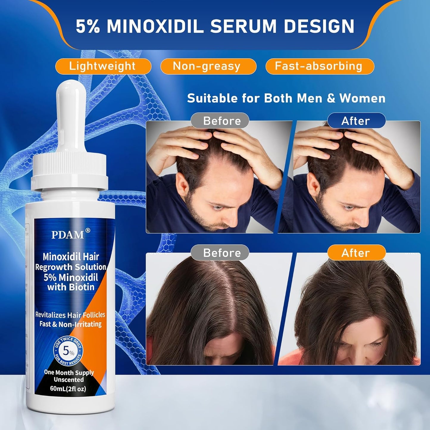 5% Minoxidil for Men Hair & Beard Growth Kit, Minoxidil for Women Hair Growth Serum, Extra Strength Hair Loss Treatment for Thinning Hair, Promotes Thicker Fuller Regrowth, Nourishes Scalp, 2oz